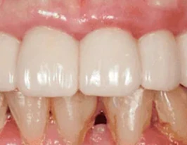 Natural Gum Integration
