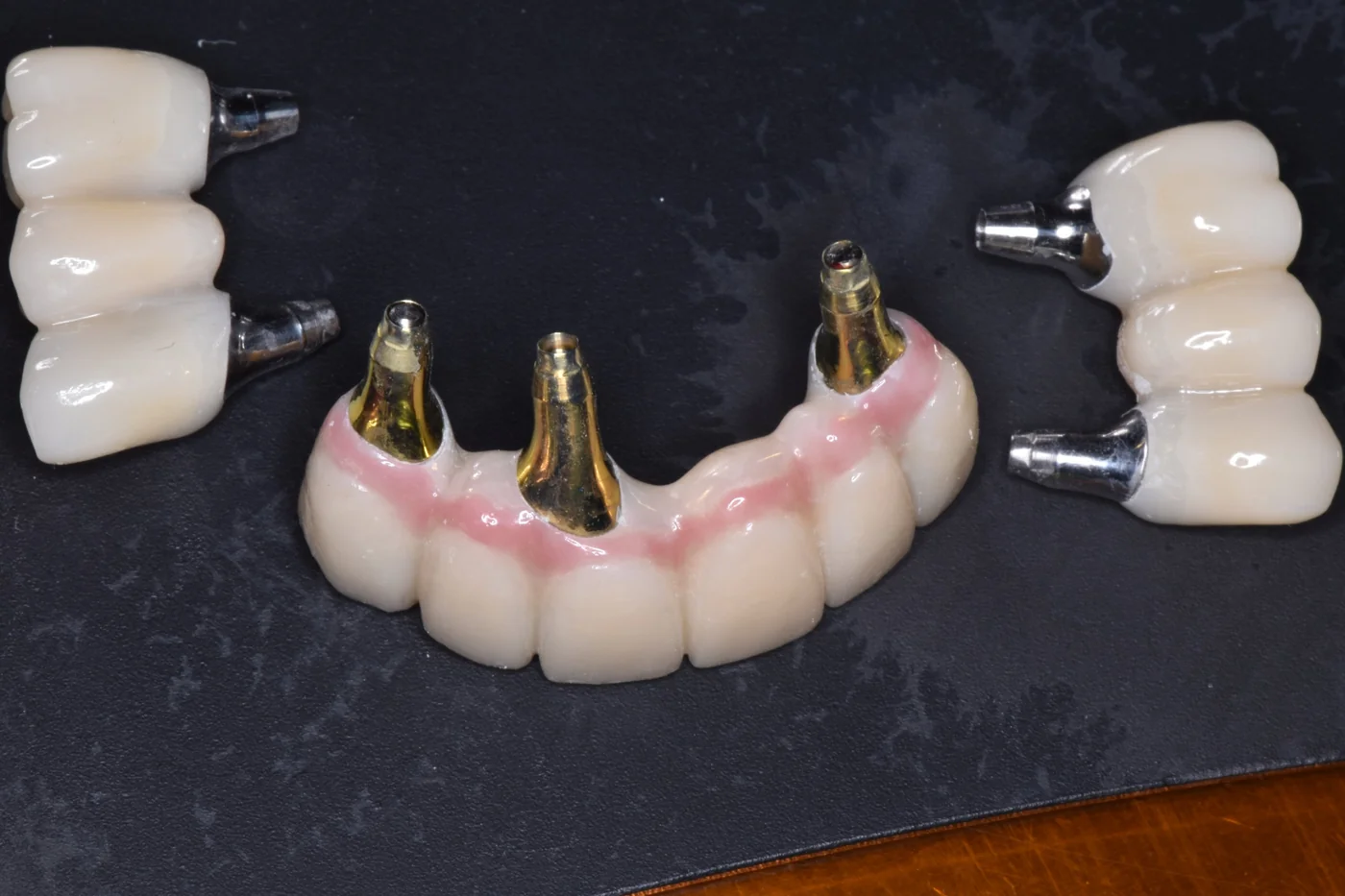 3-On-6™ prosthesis segments with implant abutments, before installation