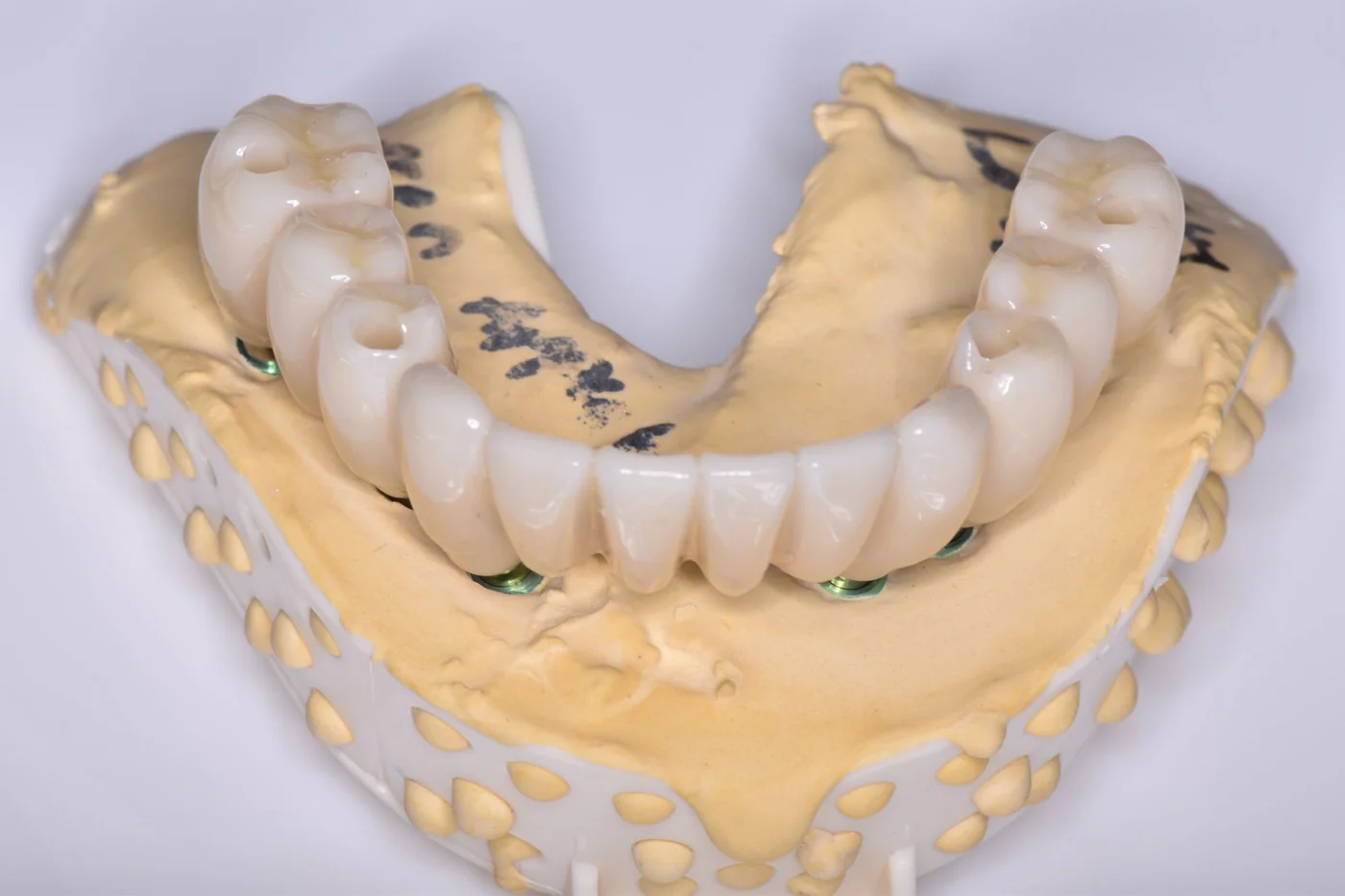 3-On-6™ full arch prosthesis seated on a stone model