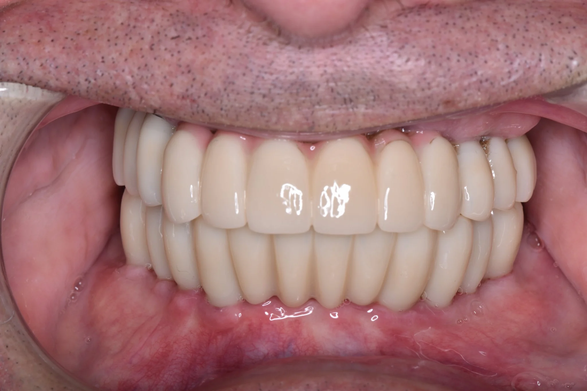 After full arch treatment