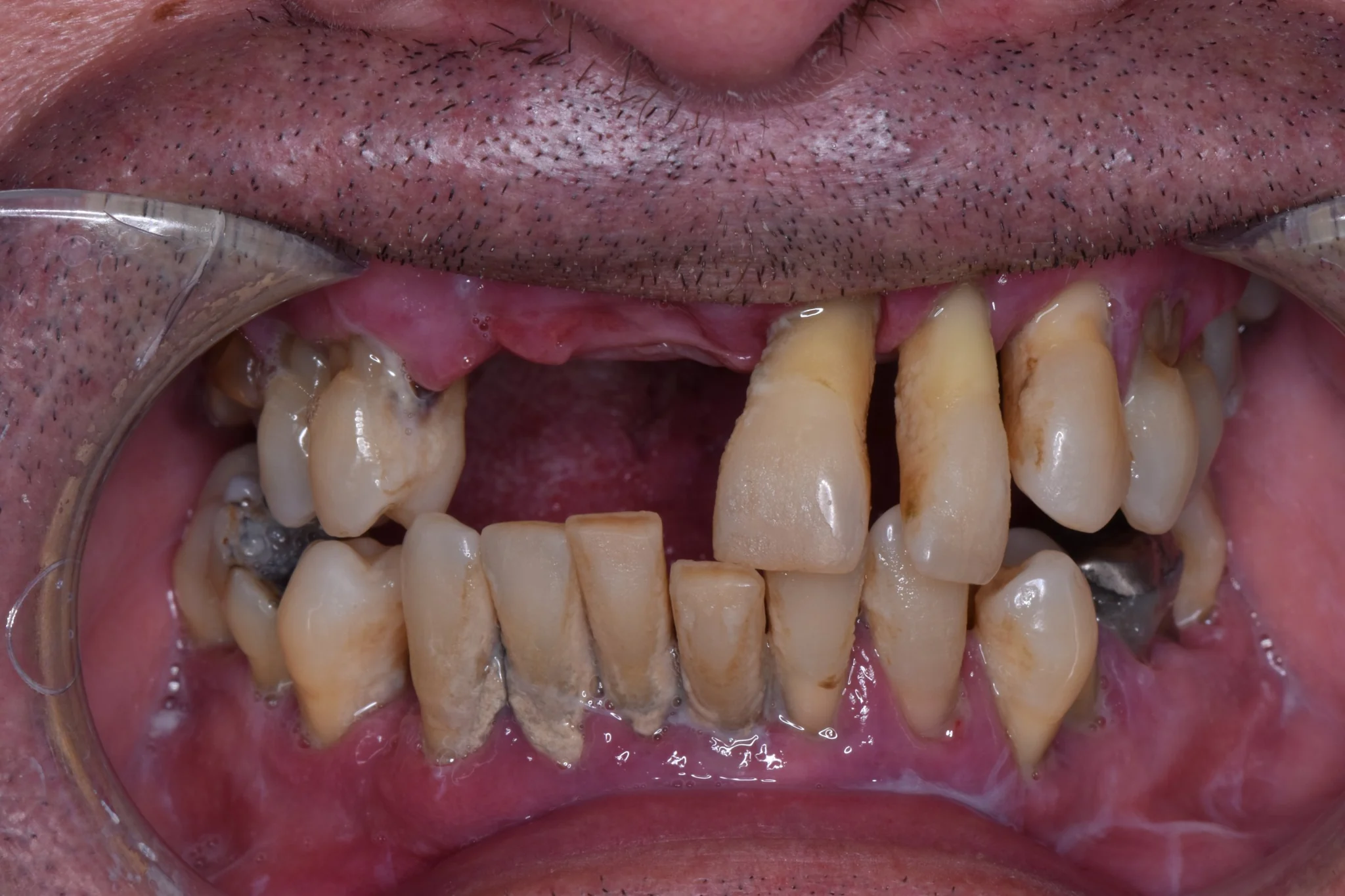 Before full arch treatment