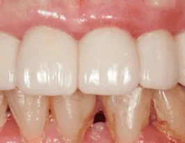 Natural Gum Integration