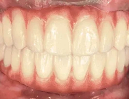 FP1 Full Arch Option